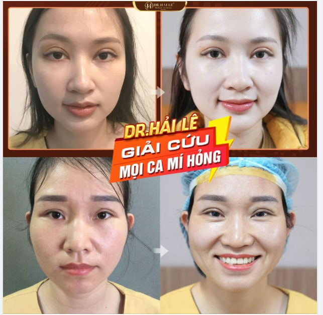 Review bằng hình ảnh kết quả sửa mí tại Dr.Hải Lê.