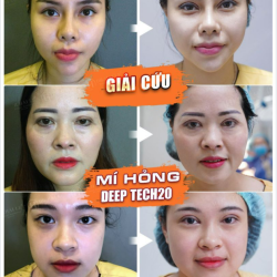 REVIEW KẾT QUẢ GIẢI CỨU MÍ HỎNG TẠI DR.HẢI LÊ