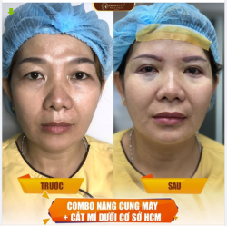 REVIEW KẾT QUẢ NÂNG CUNG MÀY + CẮT MÍ DƯỚI COMBO TRẺ HÓA MẮT CHO CHỊ EM TUỔI TRUNG NIÊN