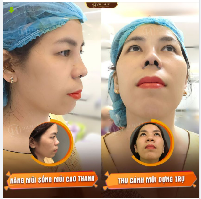 REVIEW NÂNG MŨI CƠ SỞ DR.HẢI LÊ HCM ĐỘNG LỰC NÂNG MŨI LÀ ĐÂY CHỨ ĐÂU!