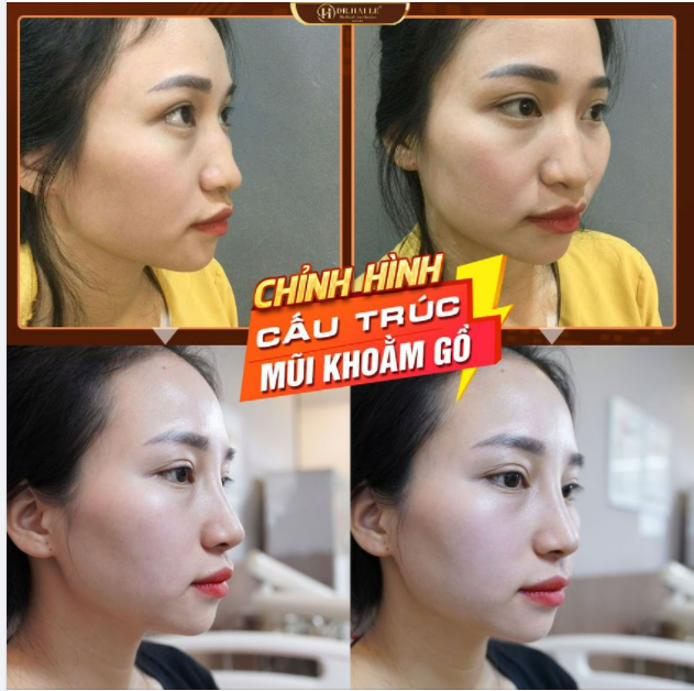 REVIEW NÂNG MŨI XÓA BỎ MŨI KHOẰM + GỒ
