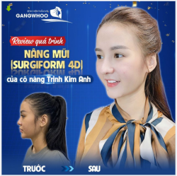 REVIEW QUÁ TRÌNH NÂNG MŨI (SURGIFORM 4D) CỦA CÔ NẦNG TRỊNH KIM ANH