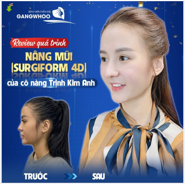 REVIEW QUÁ TRÌNH NÂNG MŨI (SURGIFORM 4D) CỦA CÔ NẦNG TRỊNH KIM ANH