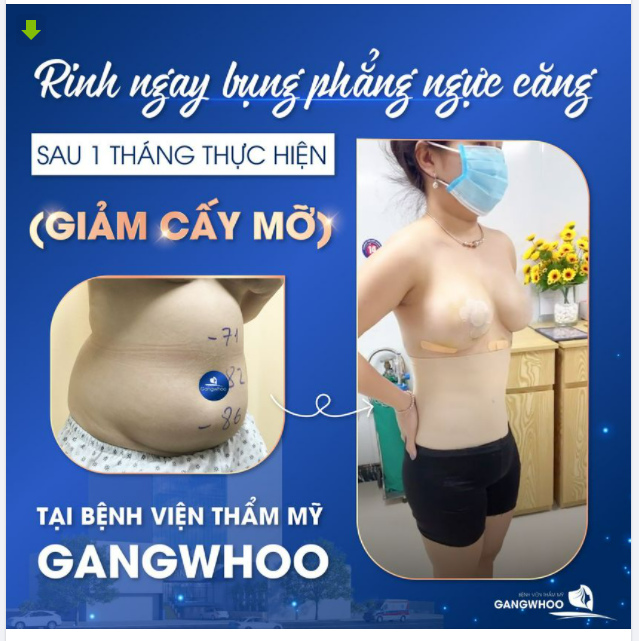 RINH NGAY BỤNG PHẲNG NGỰC CĂNG NGAY SAU 1 THÁNG SỬ DỤNG HÚT-CẤY MỠ TỰ THÂN TẠI BỆNH VIỆN THẨM MỸ GANGWHOO