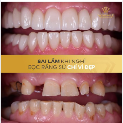 SAI LẦM KHI NGHĨ BỌC SỨ CHỈ VÌ ĐẸP
