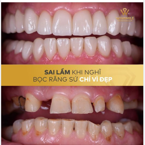 SAI LẦM KHI NGHĨ BỌC SỨ CHỈ VÌ ĐẸP