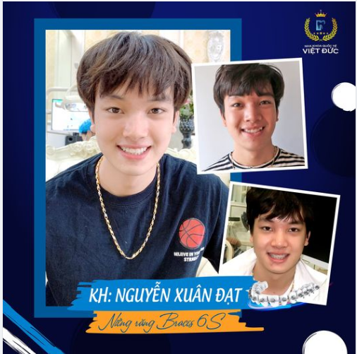 “San bằng” Răng khấp khểnh 9630 sau niềng răng Braces 6S