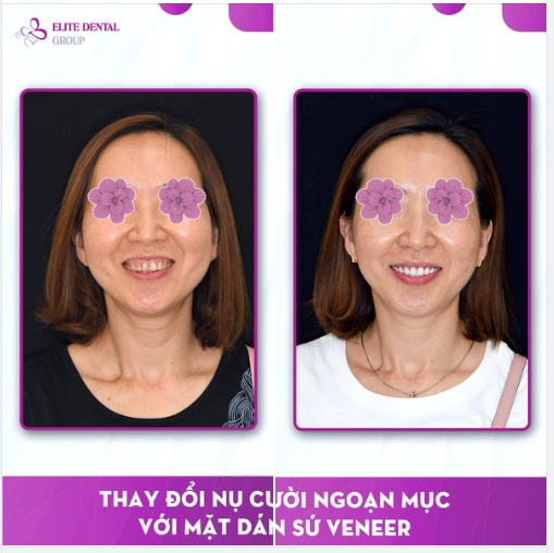 Sau 10 ngày được Bác sĩ chuyên khoa tại Elite Dental “phù phép” bằng phương pháp veneer sứ, chị N. đã có nụ cười mới như mơ ước