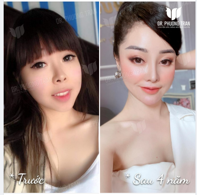 SAU 4 NĂM NÂNG MŨI LIỆU CÓ CÒN ĐẸP KHÔNG?