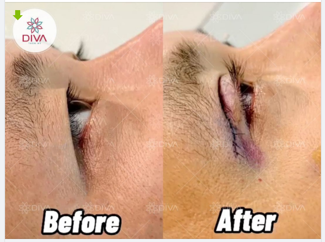 SAU CẮT MÍ MẮT CHĂM SÓC NHƯ THẾ NÀO?