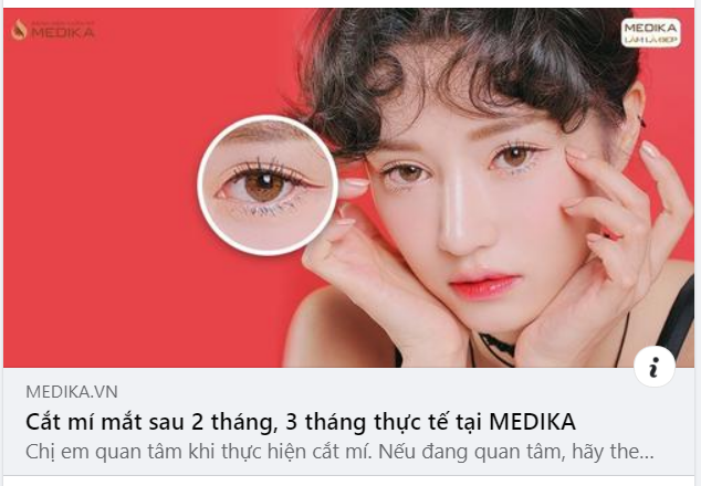 Sau cắt mí mắt thì mắt sẽ trông thế nào?