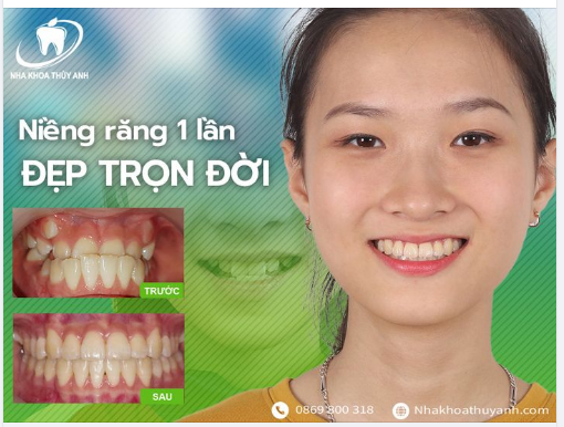 SAU HƠN 2 NĂM NIỀNG RĂNG, KẾT QUẢ BẠN NHẬN ĐƯỢC LÀ GÌ