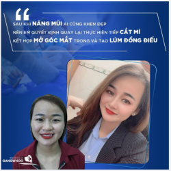 "Sau khi nâng mũi ai cũng khen đẹp hết nên em quyết định quay lại để thực hiện tiếp cắt mí kết hợp mở góc mắt trong và tạo lúm đồng điếu"