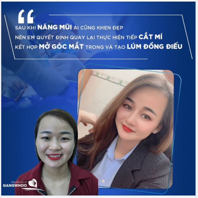 "Sau khi nâng mũi ai cũng khen đẹp hết nên em quyết định quay lại để thực hiện tiếp cắt mí kết hợp mở góc mắt trong và tạo lúm đồng điếu"