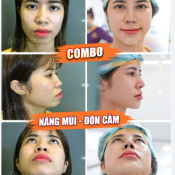 SIÊU PHẨM COMBO NÂNG MŨI + ĐỘN CẰM V-LINE "Thật đáng đồng tiền bát gạo" "ưng hết sức"