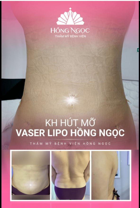 SIÊU PHẨM EO CON KIẾN SAU 2 NGÀY HÚT MỠ HỒNG NGỌC