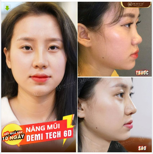 Siêu phẩm nâng mũi Demi Tech 6D tại Dr.Hải Lê - các chị em đừng nên bỏ lỡ.