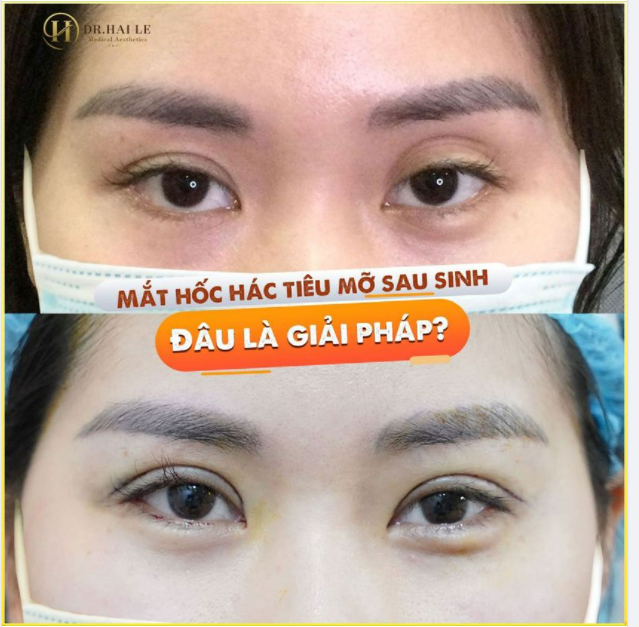 Sinh con xong mắt đang đẹp trở nên xấu.....Tóc rụng, bụng ngấn mỡ, body chảy xệ...không còn xa lạ