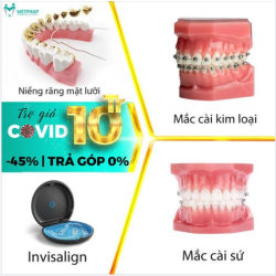 Smart Clip 3D Công nghệ Số 1 cho hàm Hô - Móm - Khấp Khểnh