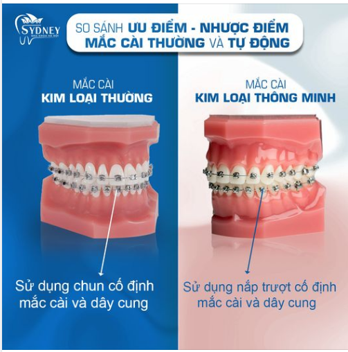 SO SÁNH MẮC CÀI THƯỜNG VÀ MẮC CÀI TỰ ĐỘNG