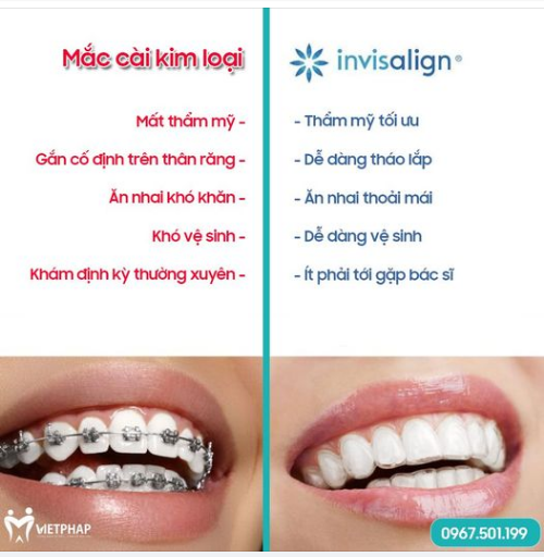 SO SÁNH NIỀNG RĂNG MẮC CÀI VÀ NIỀNG RĂNG INVISALIGN