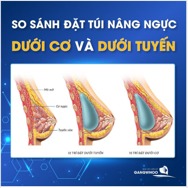 SO SÁNH ƯU, NHƯỢC ĐIỂM CỦA ĐẶT TÚI NGỰC DƯỚI CƠ VÀ DƯỚI TUYẾN