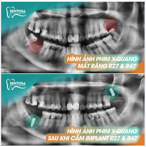 SỐNG TRỌN VẸN TỪNG KHOẢNH KHẮC NHỜ CÓ RĂNG IMPLANT