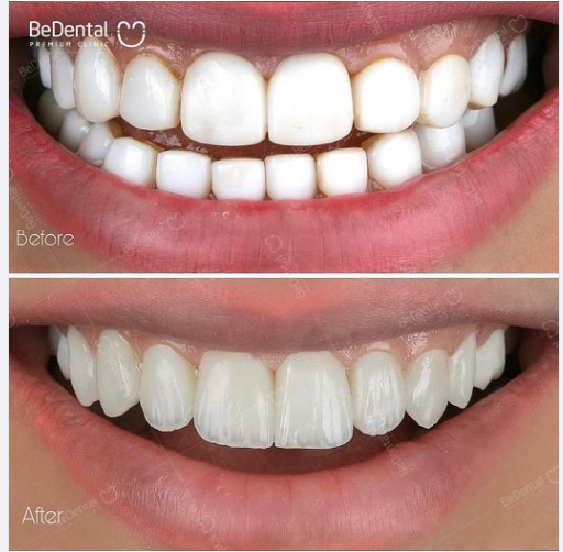 SỰ KHÁC BIỆT giữa răng PHỦ SỨ NANO (hay còn được quảng cáo là dán sứ Diamond, dán sứ sinh học) và RĂNG SỨ ĐẠT CHUẨN