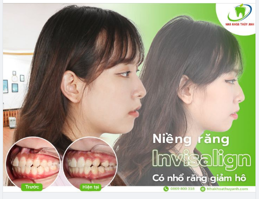 SỰ THAY ĐỔI CỦA KHÁCH HÀNG SAU 9 THÁNG NIỀNG RĂNG INVISALIGN