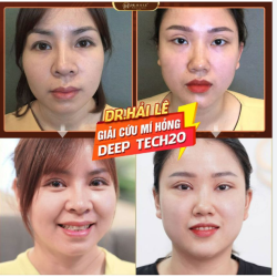 SỬA LẠI ĐÔI MẮT “TÌM LẠI NỤ CƯỜI” VỚI CN DEEP TECH20.!!