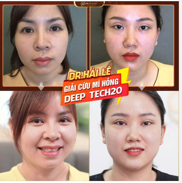 SỬA LẠI ĐÔI MẮT “TÌM LẠI NỤ CƯỜI” VỚI CN DEEP TECH20.!!
