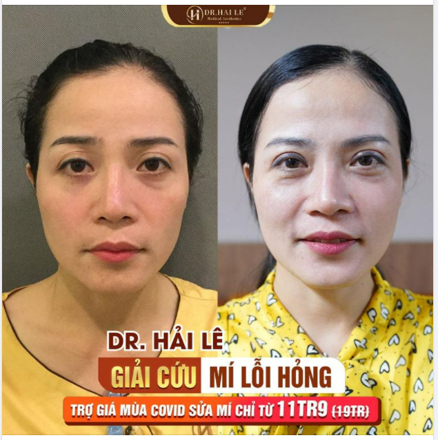 SỬA MÍ DEEP TECH20 - Đôi mắt đẹp của khách hàng là niềm vui của Dr.Hải Lê