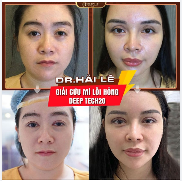 SỬA MÍ DEEP TECH20 - DR.HẢI LÊ TỰ HÀO LÀ ĐỊA CHỈ ĐI ĐẦU SỬA MÍ LỖI, HỎNG