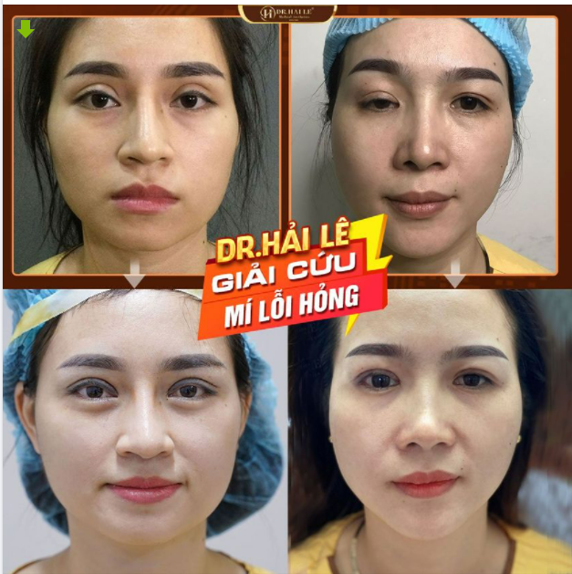 SỬA MÍ DEEP TECH20 - SỬA LẠI ĐÔI MẮT “ĐỔI LẤY NỤ CƯỜI”.!!