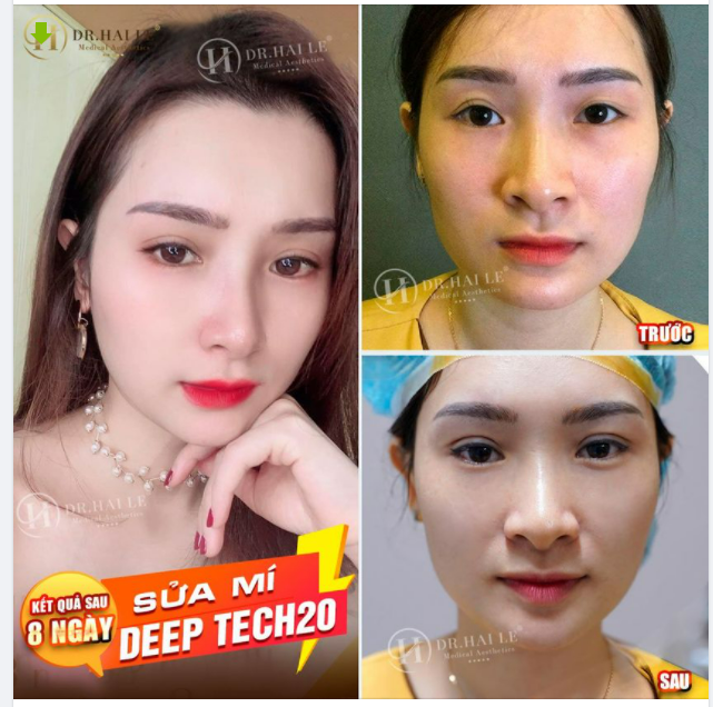 SỬA MÍ DEEP TECH20 - TÌM LẠI ĐÔI MẮT ĐẸP, TÌM LẠI SỰ TỰ TIN TRONG CUỘC SỐNG.!