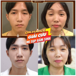 SỬA MÍ MÍ MẮT SỤP BẨM SINH NHỮNG ĐIỀU CẦN BIẾT