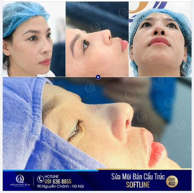 SỬA MŨI HỎNG KHÔNG CẦN NGHỈ DƯỠNG