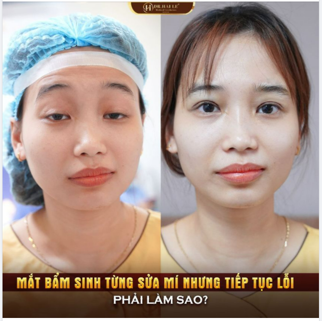 SỤP MÍ MẮT NGUYÊN NHÂN/ CƠ CHẾ CÁCH ĐIỀU TRỊ