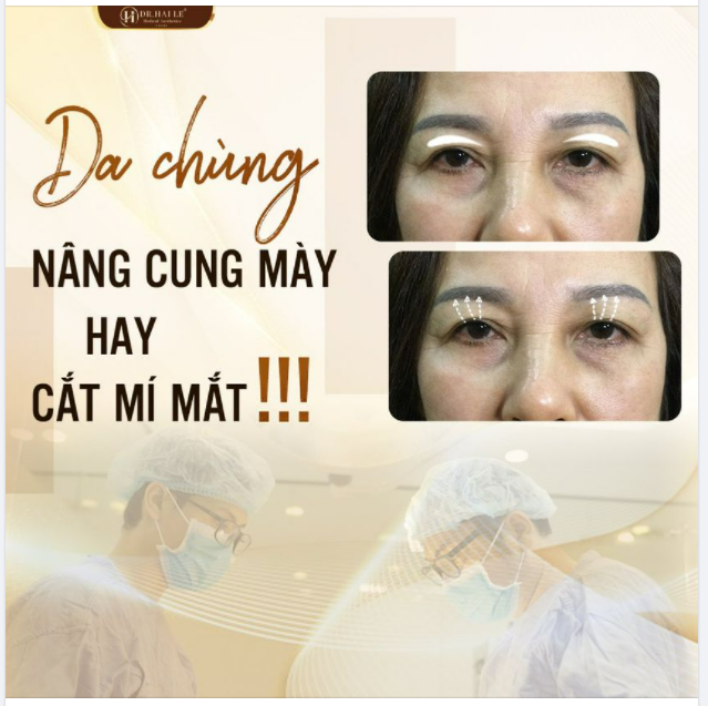 SỤP MÍ? NÊN NÂNG CUNG MÀY HAY CẮT MÍ MẮT