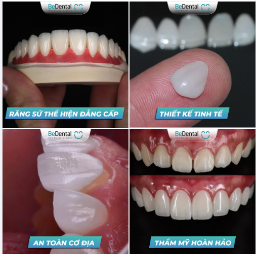 Tại sao khách hàng nên chọn làm răng sứ thay vì tẩy trắng răng hoặc sau khi niềng răng