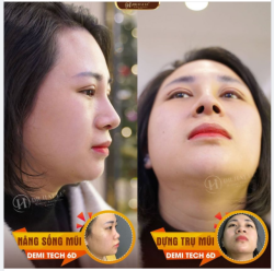 TẠI SAO MŨI NHIỀU KHUYẾT ĐIỂM NÊN CHỌN NÂNG MŨI DEMI TECH 6D TẠI DR.HẢI LÊ?