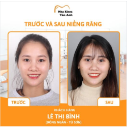 TẠI SAO PHẢI CHỤP PHIM TRƯỚC KHI NIỀNG RĂNG