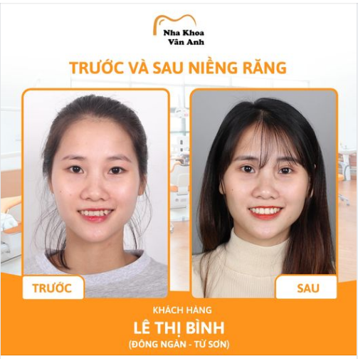 TẠI SAO PHẢI CHỤP PHIM TRƯỚC KHI NIỀNG RĂNG