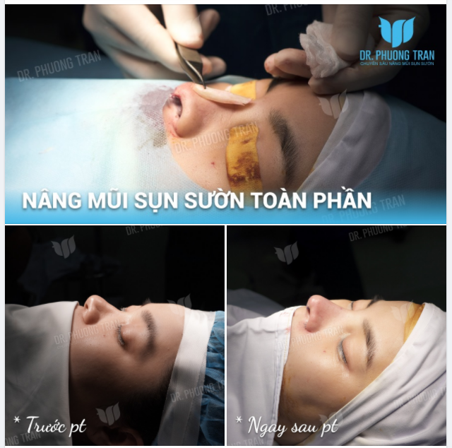 TẠI SAO SỤN SƯỜN LÀ VẬT LIỆU TỐT NHẤT TRONG PHẪU THUẬT MŨI?