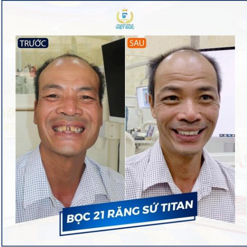 TÁI SINH RĂNG MẤT- TRẺ HÓA NỤ CƯỜI - ĂN NHAI NHƯ RĂNG THẬT SAU THẨM MỸ 21 RĂNG SỨ