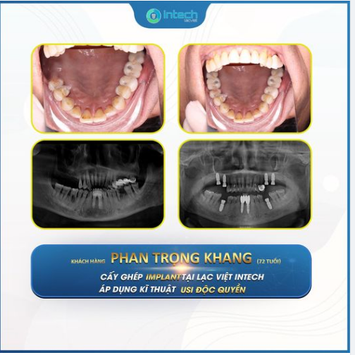 TẠM BIỆT ÁM ẢNH CẦU RĂNG, TRỒNG RĂNG IMPLANT ĂN NHAI TRỌN ĐỜI
