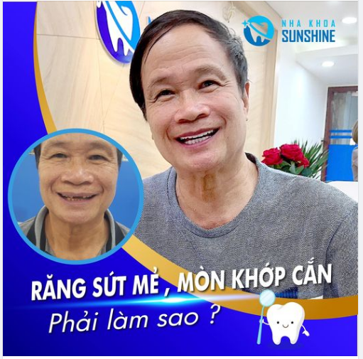 TẠM BIỆT HÀM RĂNG SỨT MẺ, Ố VÀNG, MÒN KHỚP CẮN