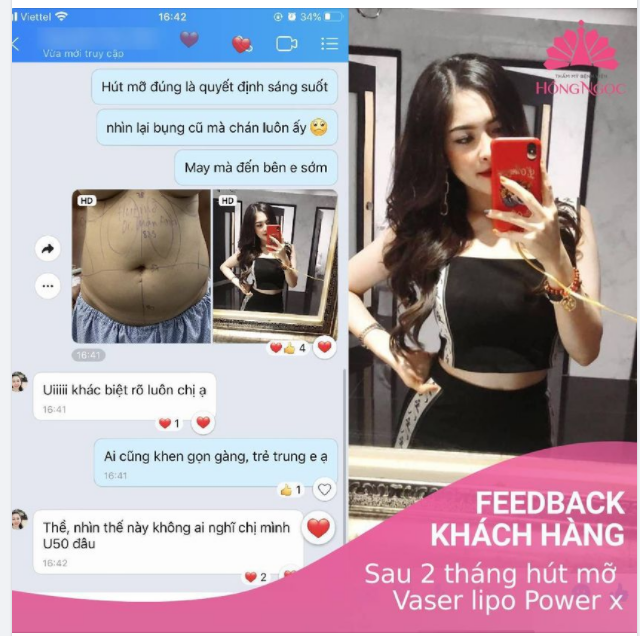 TẠM BIỆT "PHIÊN BẢN TỰ TI", U50 SỞ HỮU V2 THON GỌN SAU 2 THÁNG HÚT MỠ VASER LIPO