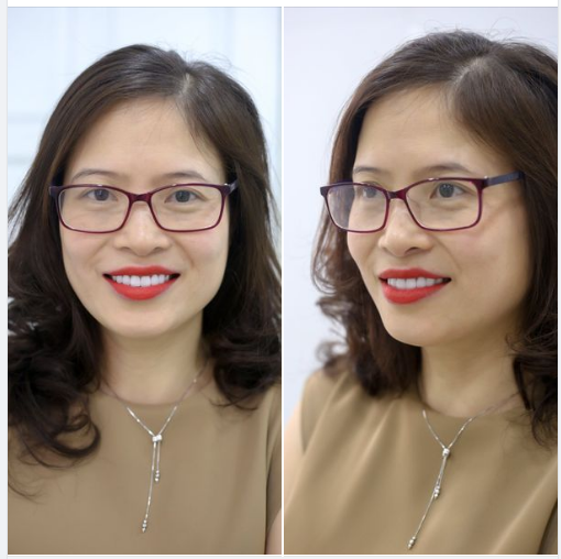 TẶNG ĐẾN 70% CHI PHÍ THẨM MỸ RĂNG CHỈ TRONG THÁNG 6