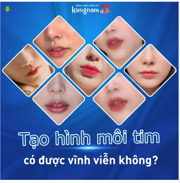 TẠO HÌNH MÔI TIM có vĩnh viễn không?